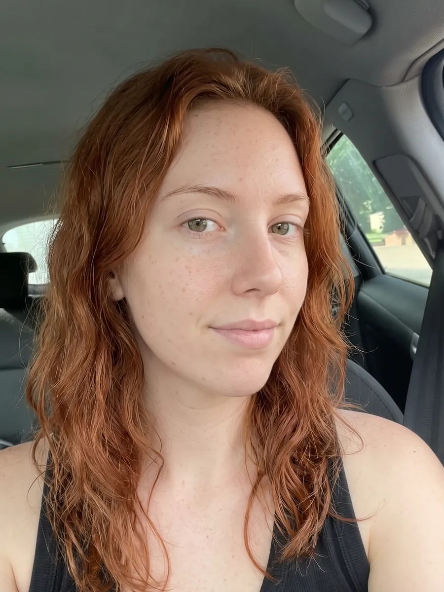 Kayla, chin augmentation, before, 3/4