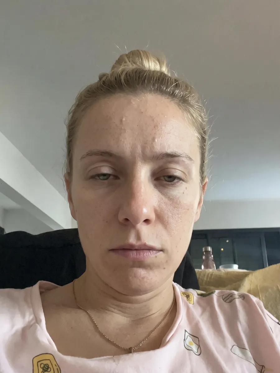 Manon, lip augmentation, before, front