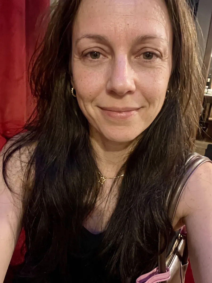 Kelly, lower blepharoplasty, after, front