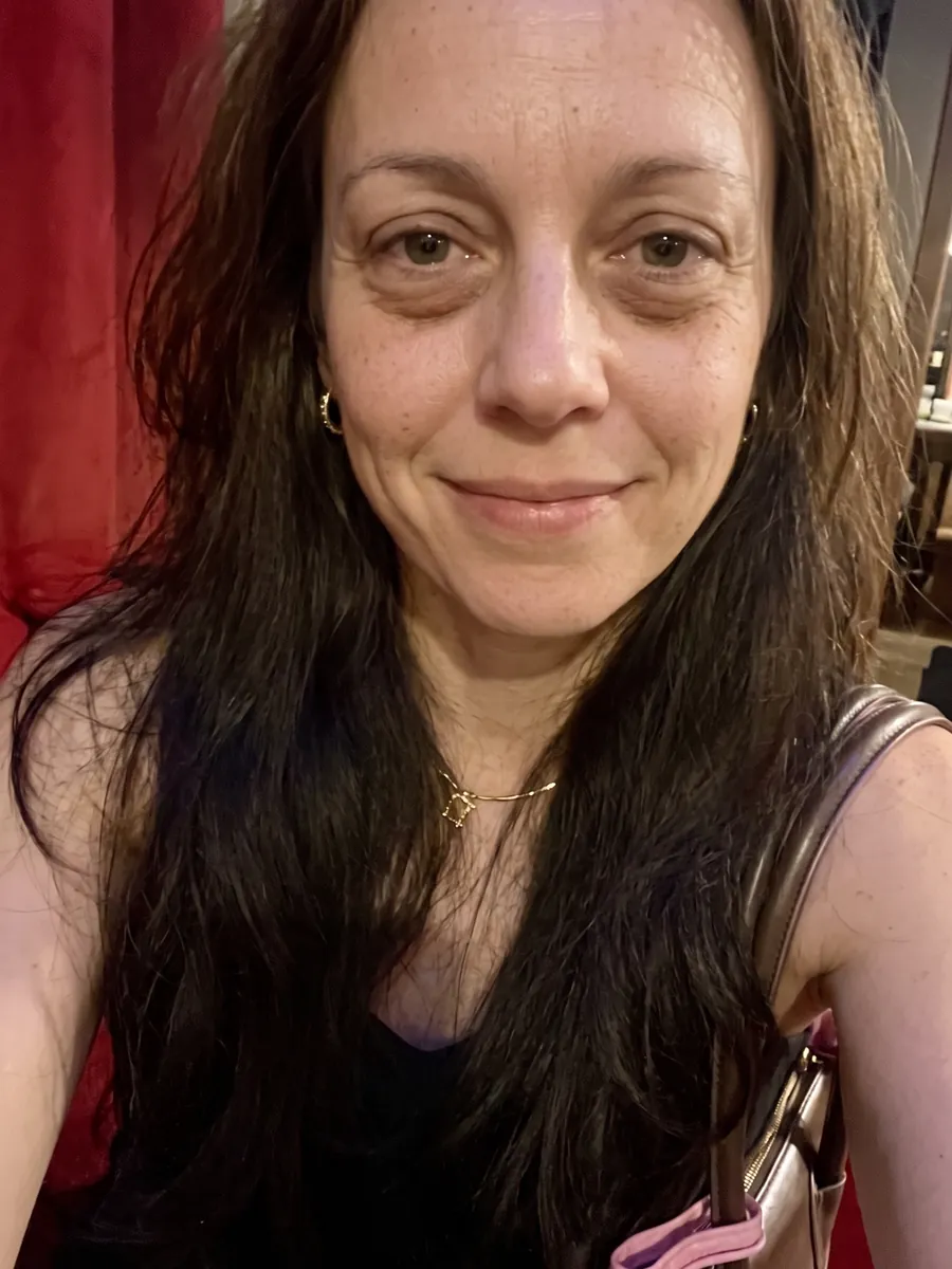 Kelly, lower blepharoplasty, before, front