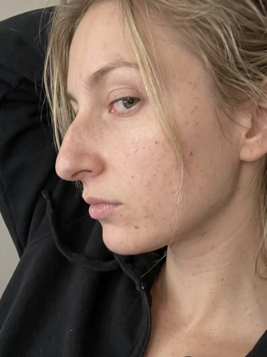 Sarah, rhinoplasty, before, profile