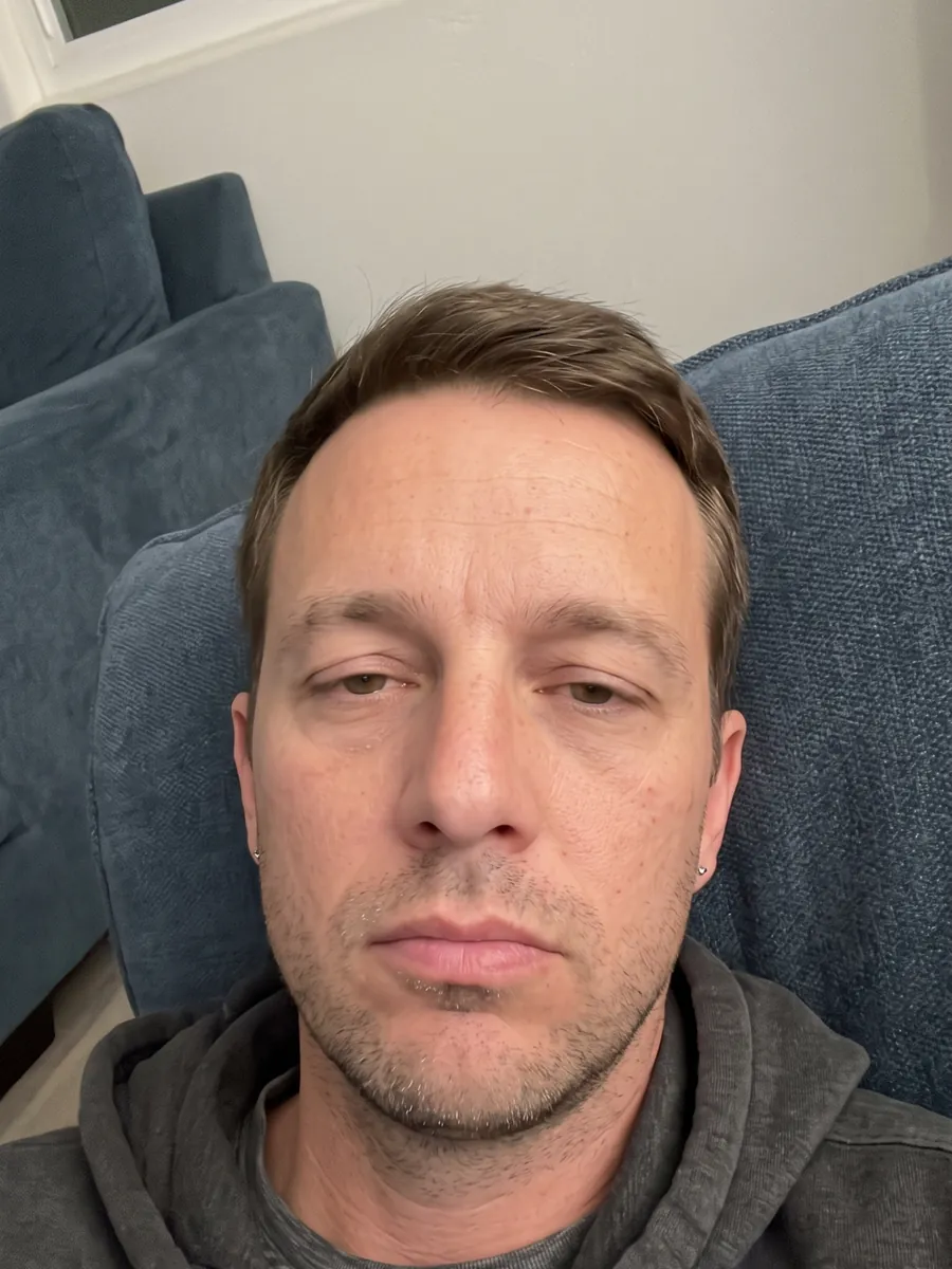 Chad, upper blepharoplasty, before, front