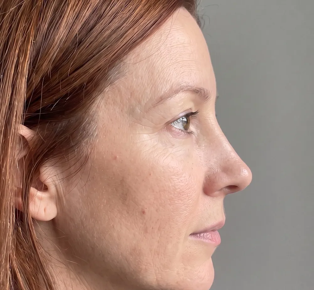 Cosmetic Preview · Rhinoplasty