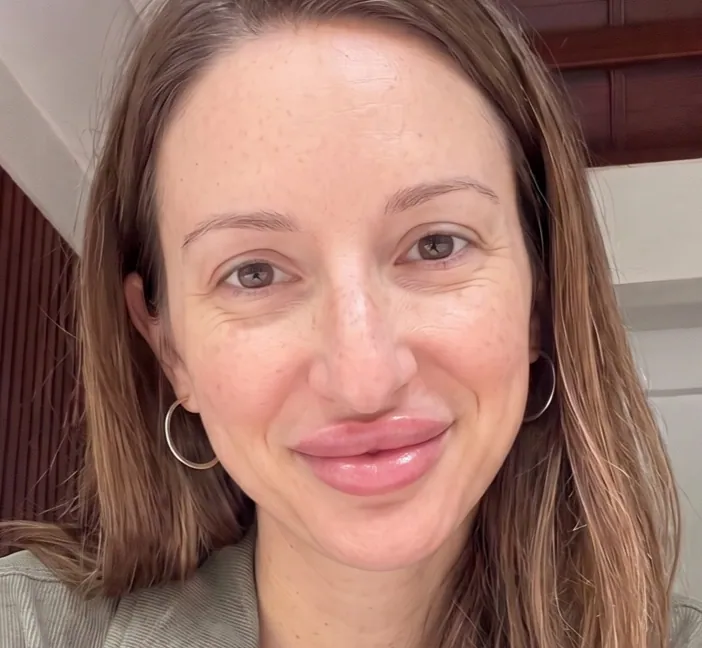 Cosmetic Preview · Lip augmentation, full