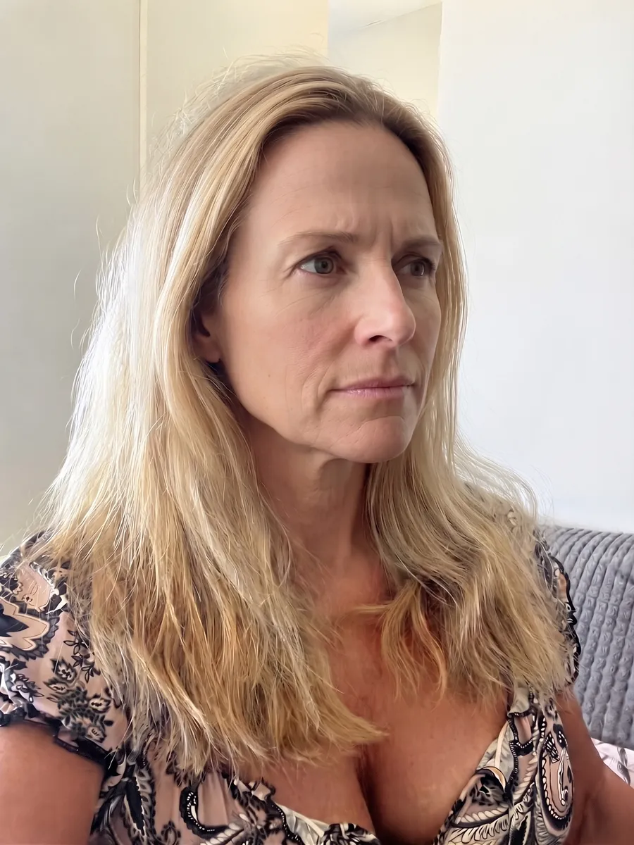 Susan, botox, moderate, front