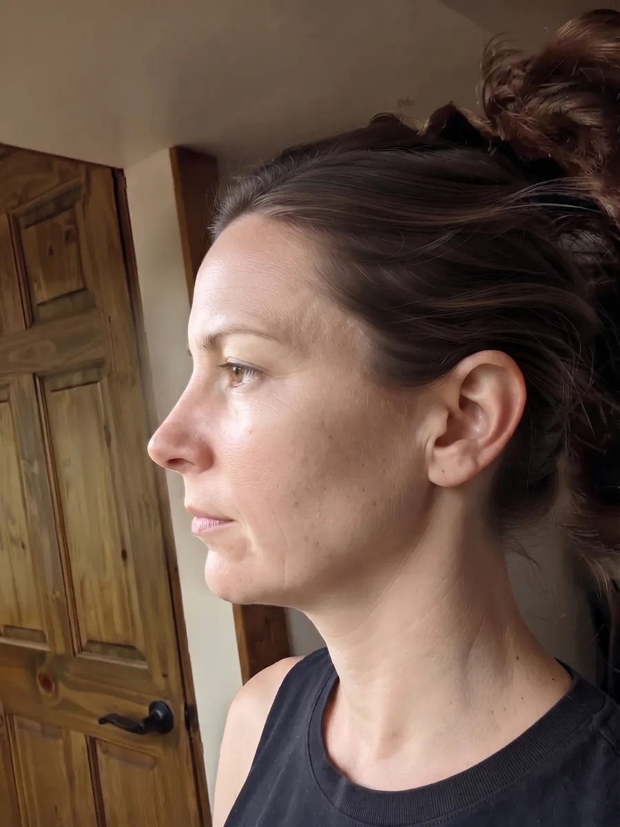 Naomi, chin augmentation, subtle, profile