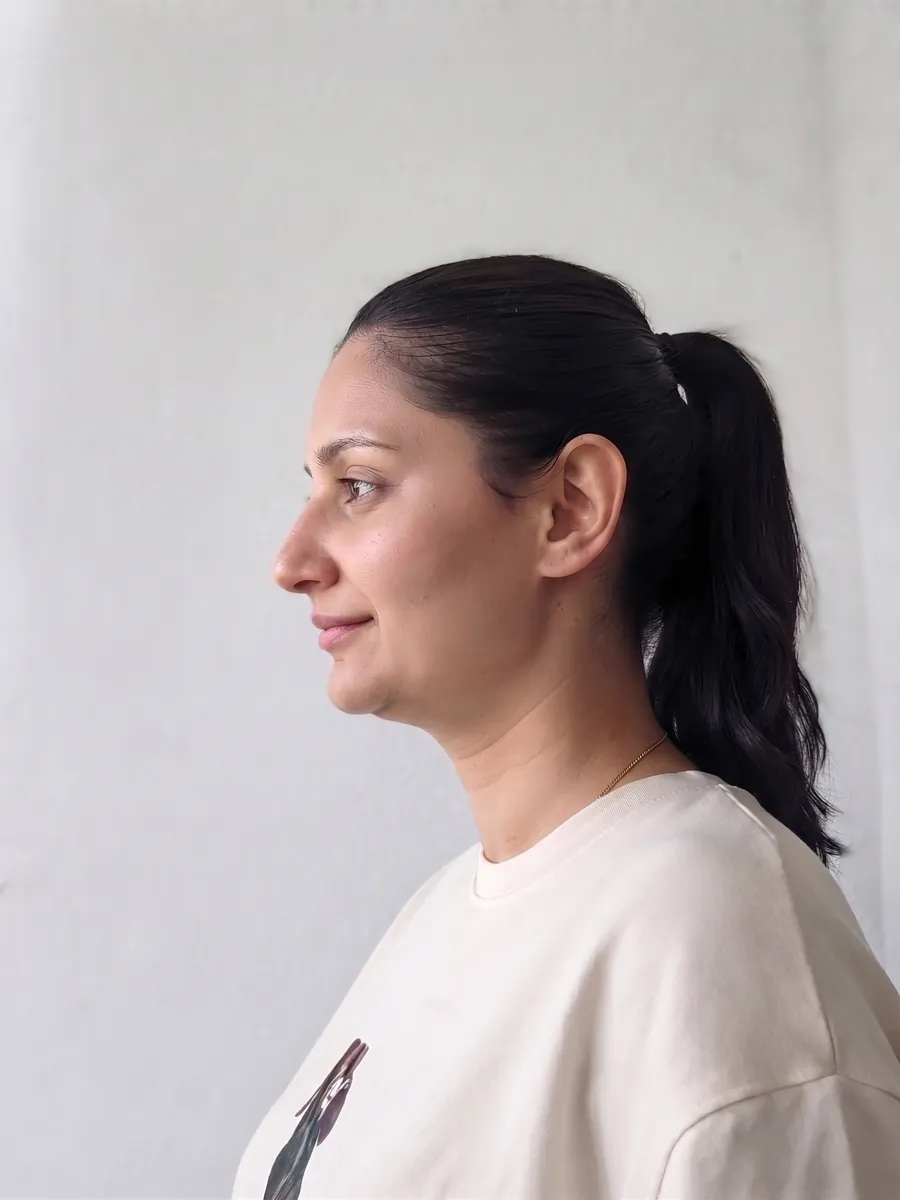 Farah, chin liposuction, subtle, profile
