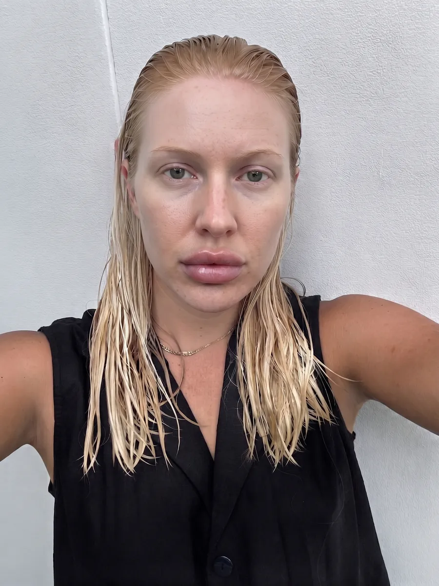 Olivia, lip augmentation, full, front