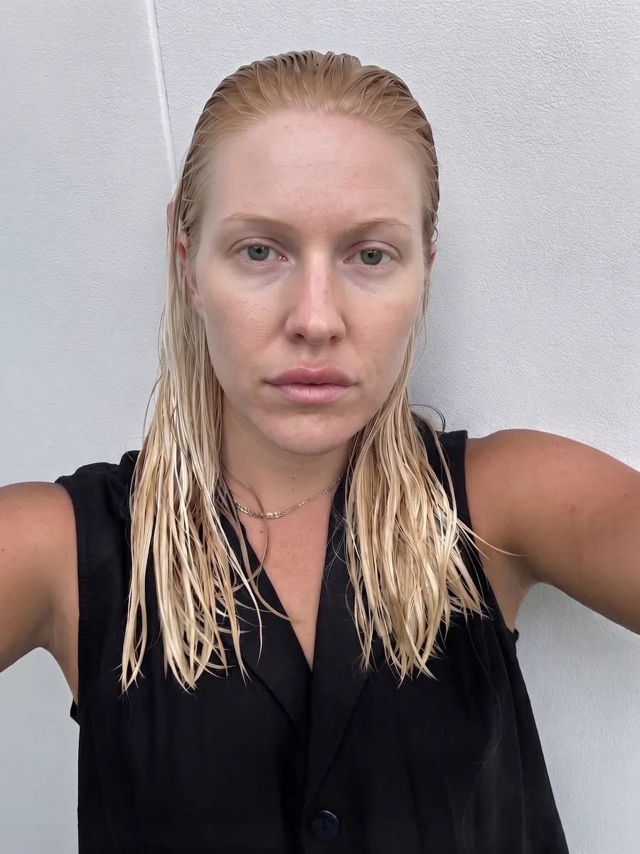 Olivia, lip lift, moderate, front