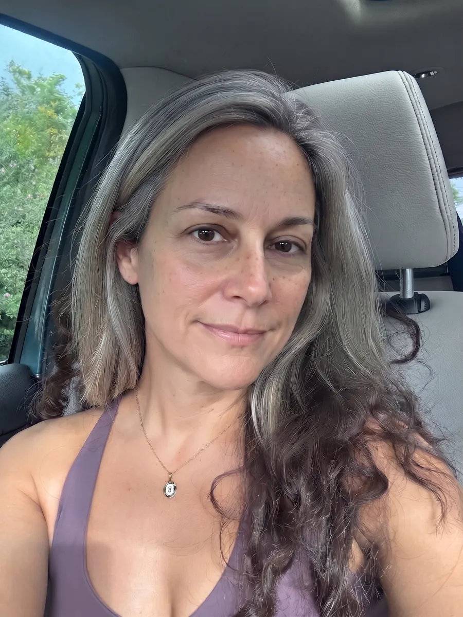 Diane, lower blepharoplasty, moderate, front