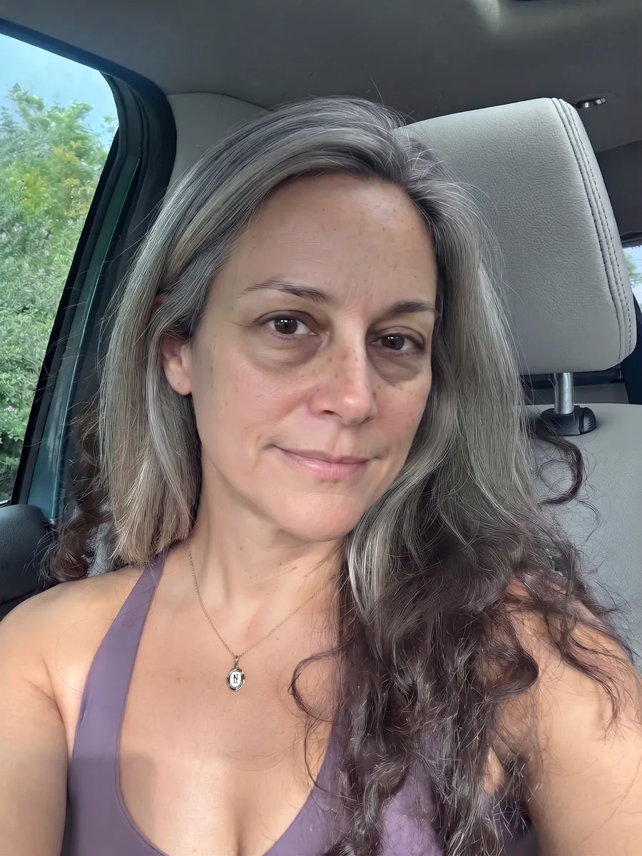Diane, lower blepharoplasty, subtle, front