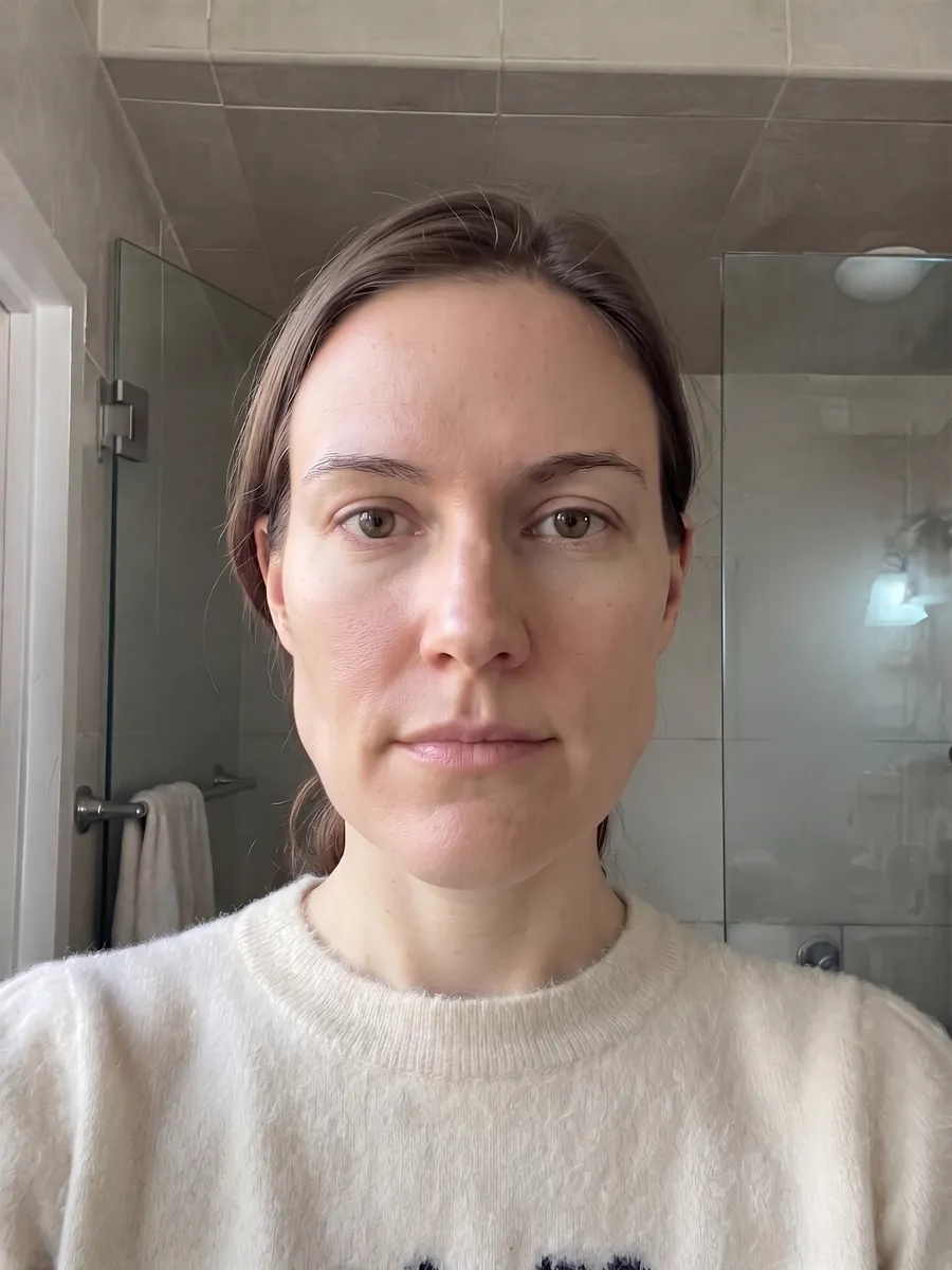 Amber, masseter botox, full, front