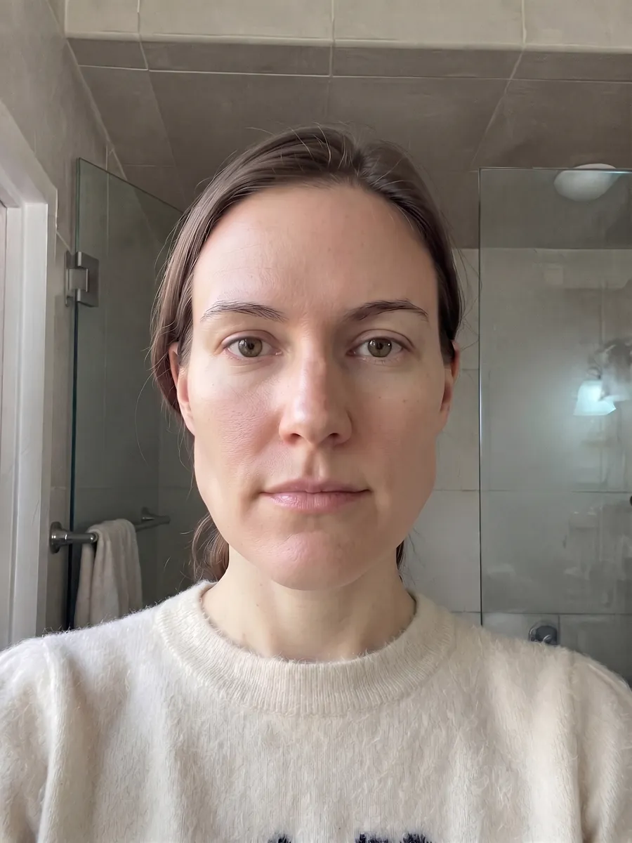 Amber, masseter botox, moderate, front