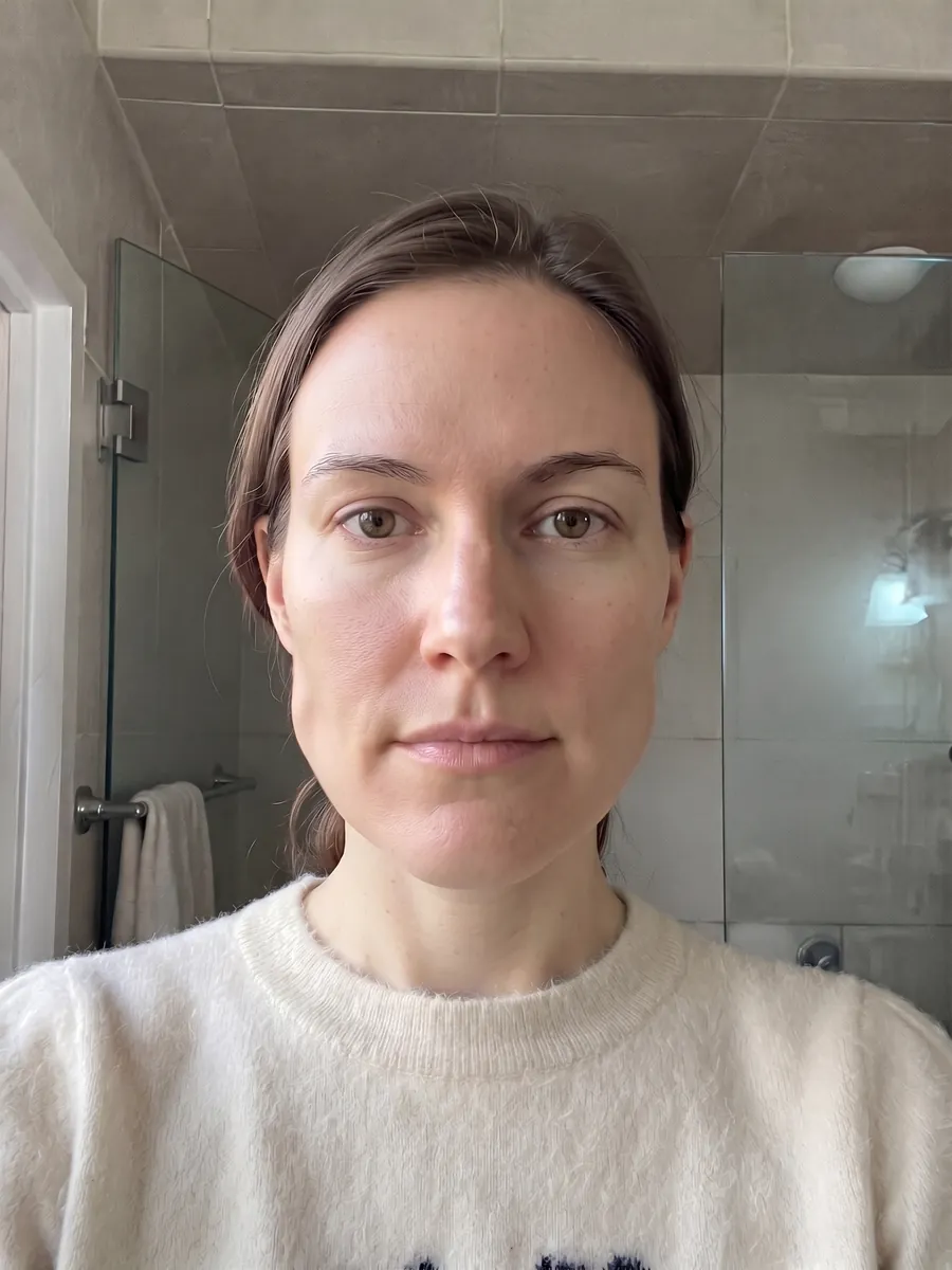 Amber, masseter botox, subtle, front