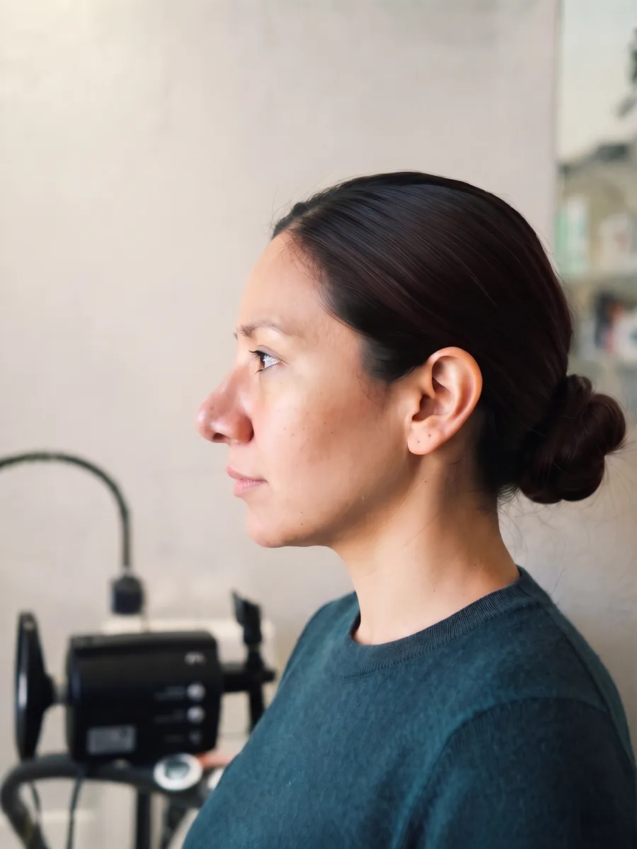 Alicia, nasal tip refinement, full, profile