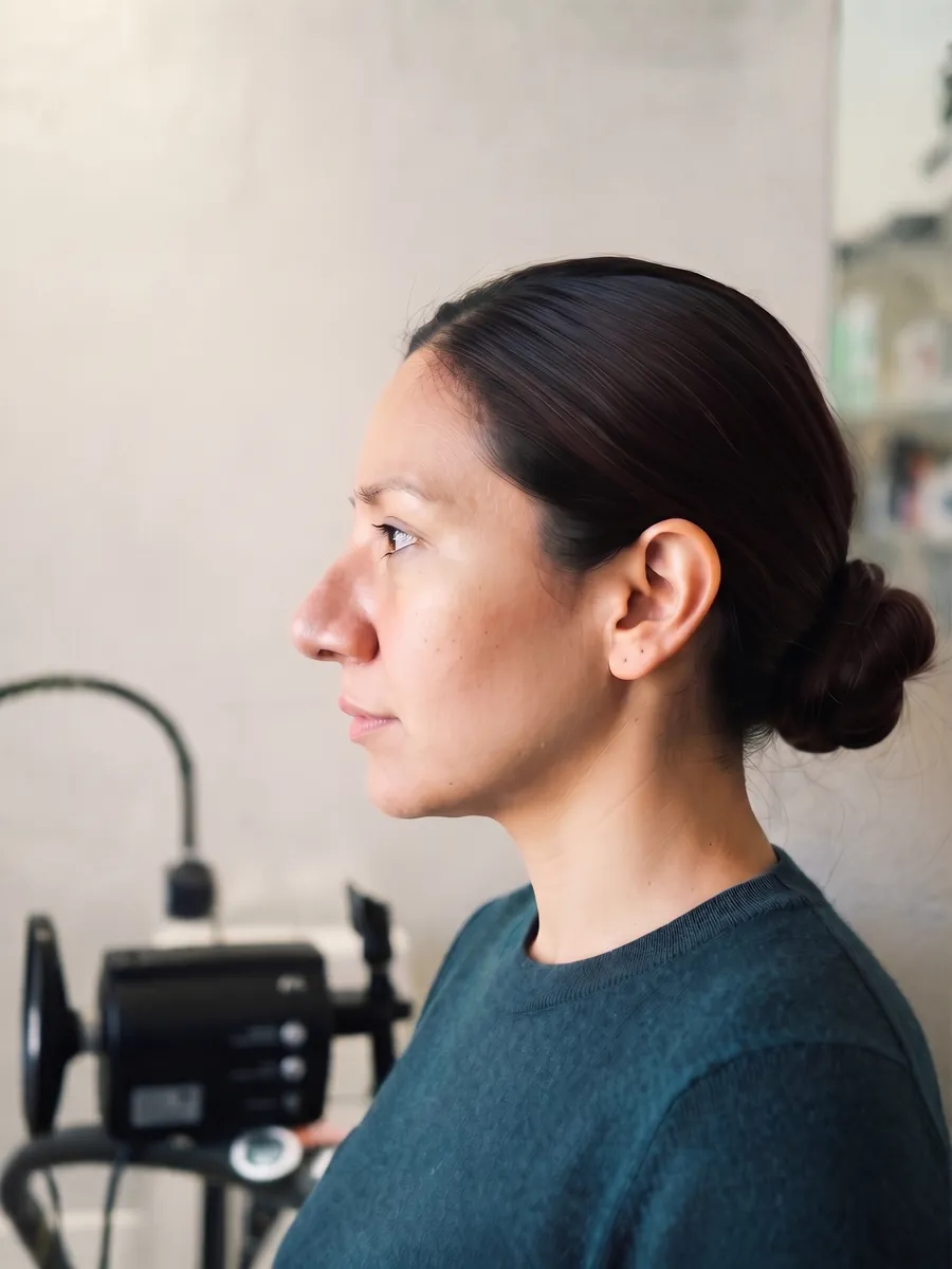Alicia, nasal tip refinement, moderate, profile