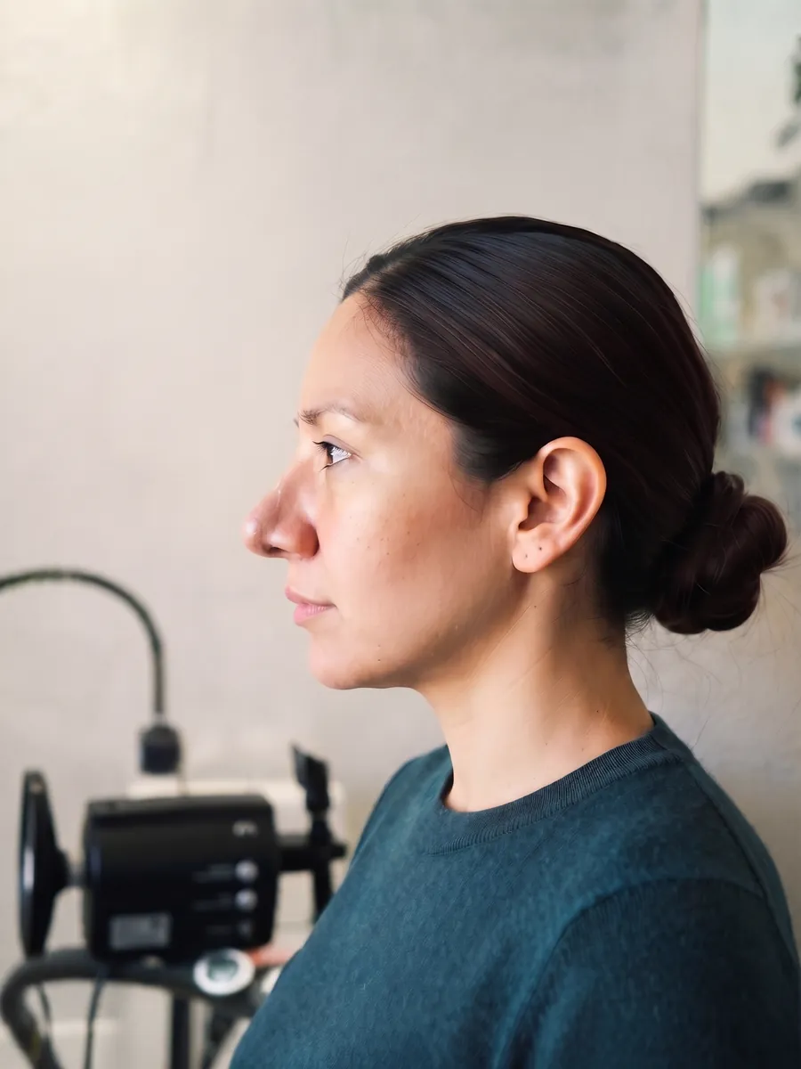 Alicia, nasal tip refinement, subtle, profile