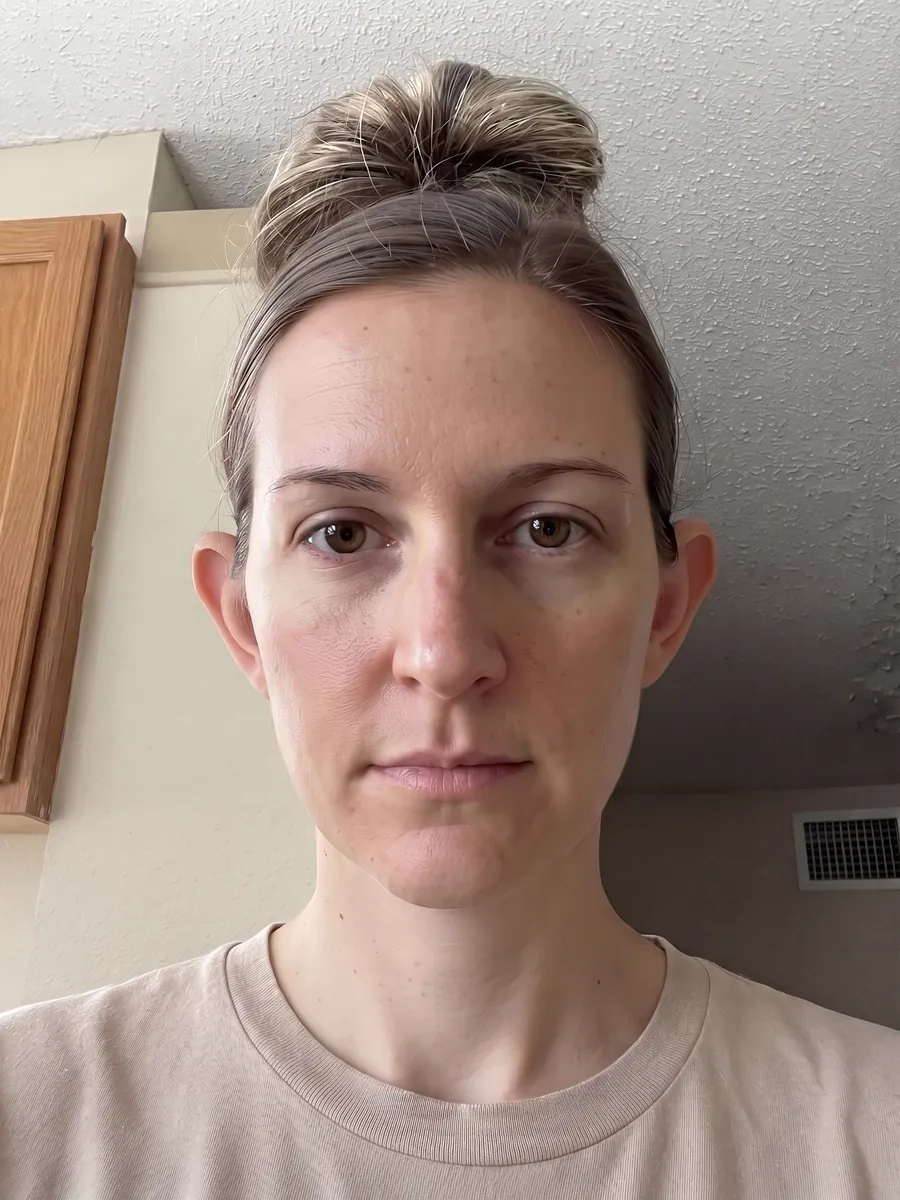 Katie, otoplasty, full, front