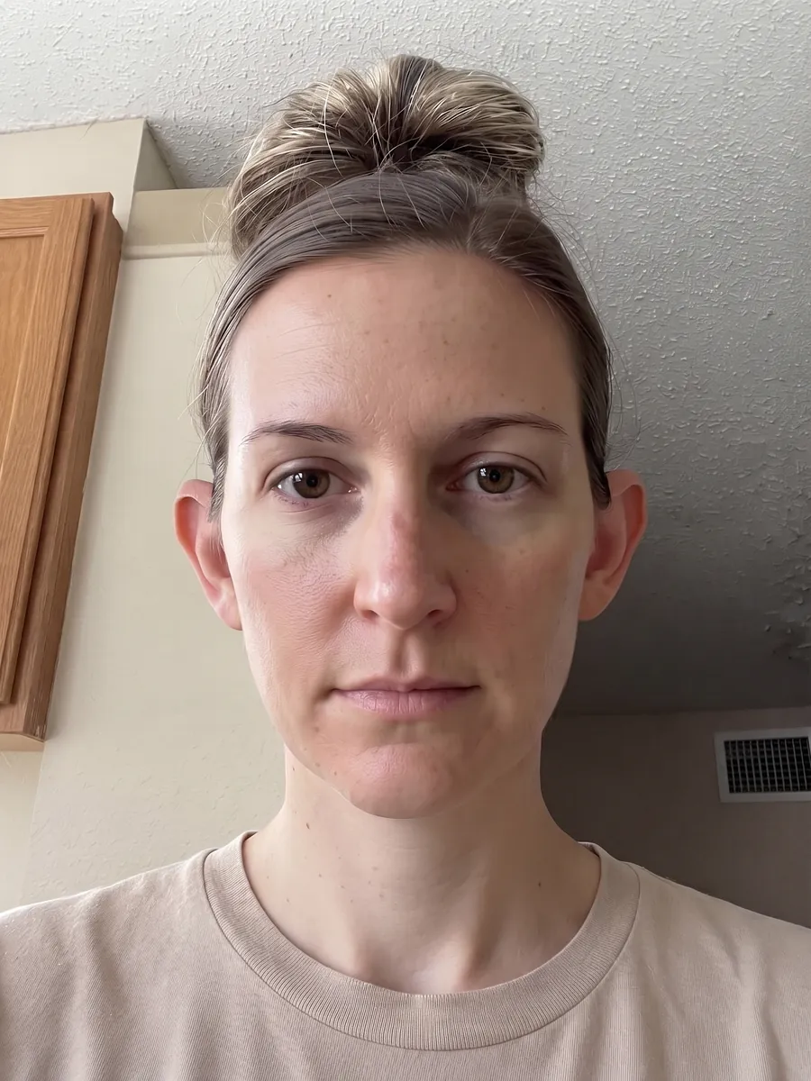 Katie, otoplasty, moderate, front