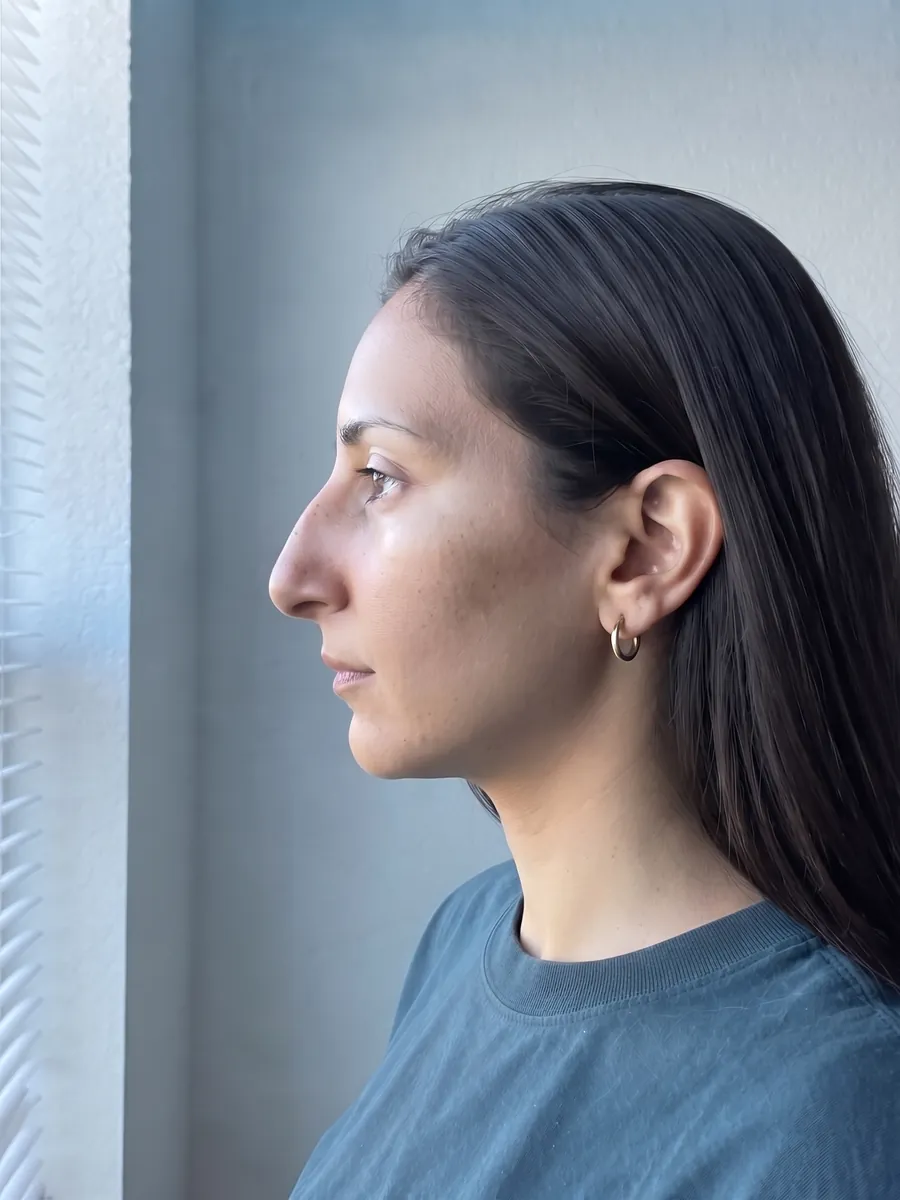 Yasmin, rhinoplasty, full, profile