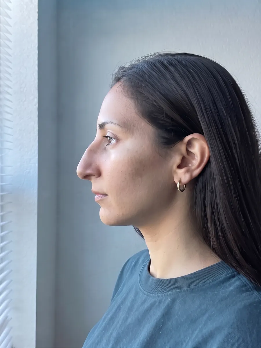 Yasmin, rhinoplasty, moderate, profile