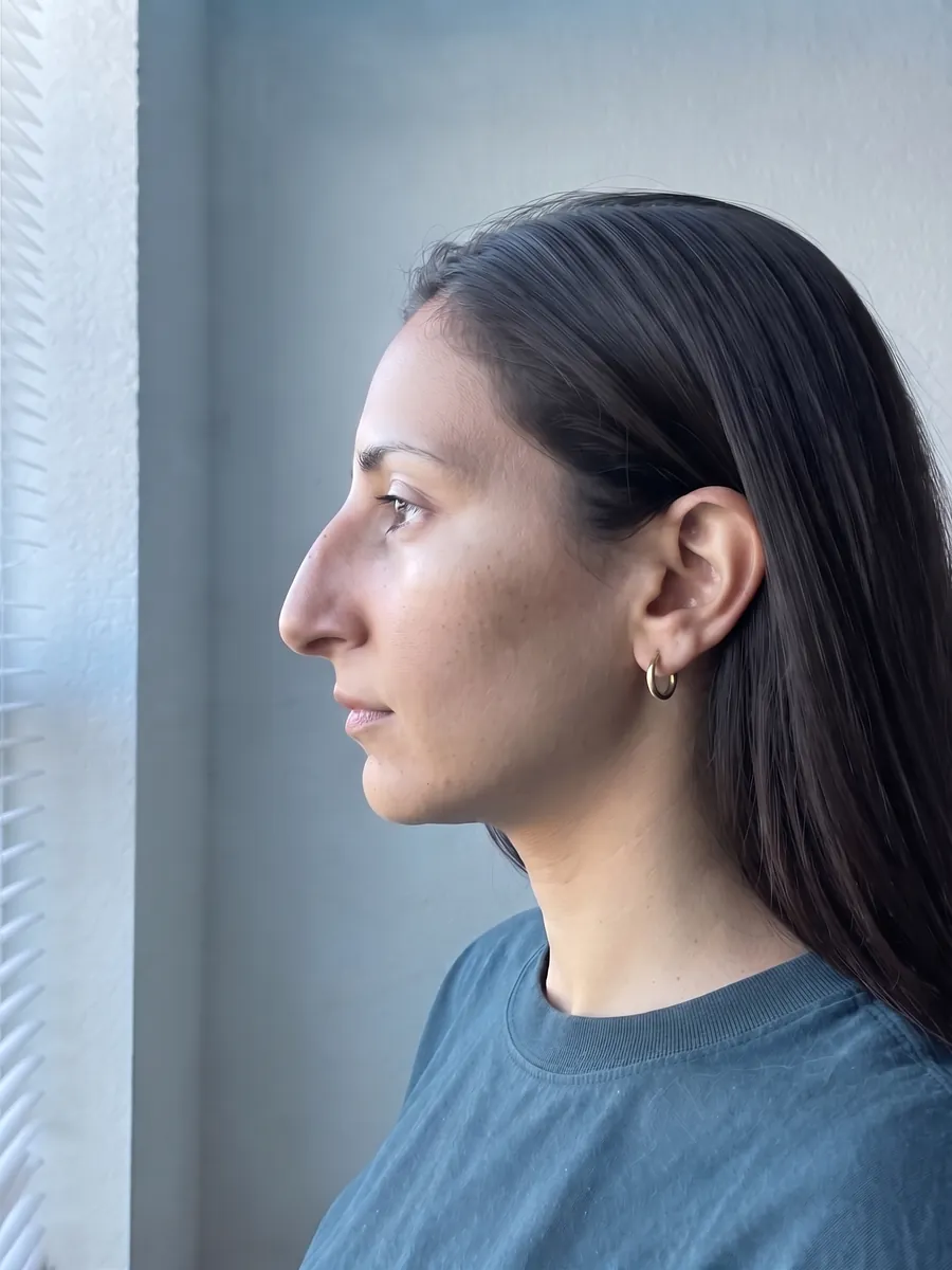 Yasmin, rhinoplasty, subtle, profile